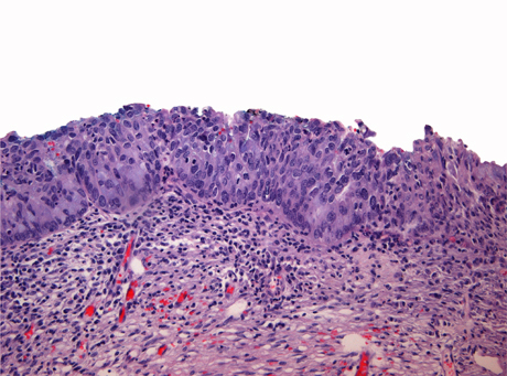Adenocarcinoma in situ Stratified type