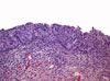 Click to view larger image of Adenocarcinoma in situ Stratified type