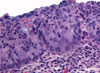 Click to view larger image of Adenocarcinoma in situ Stratified type